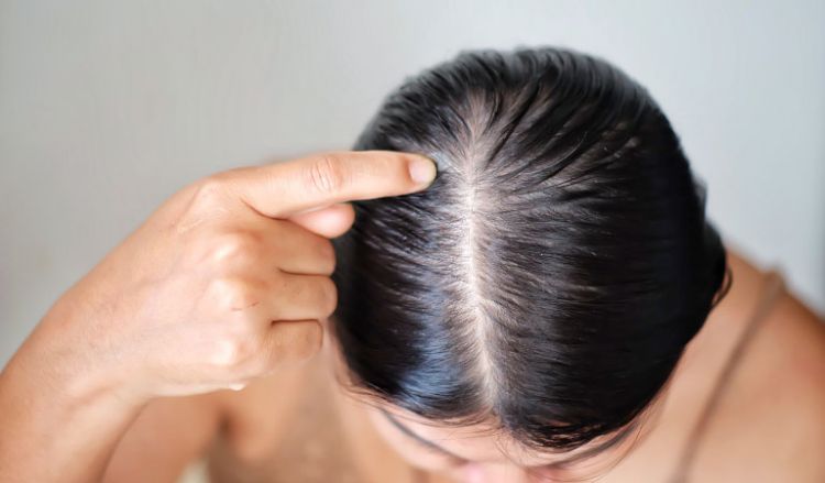 Hair Loss Preventing